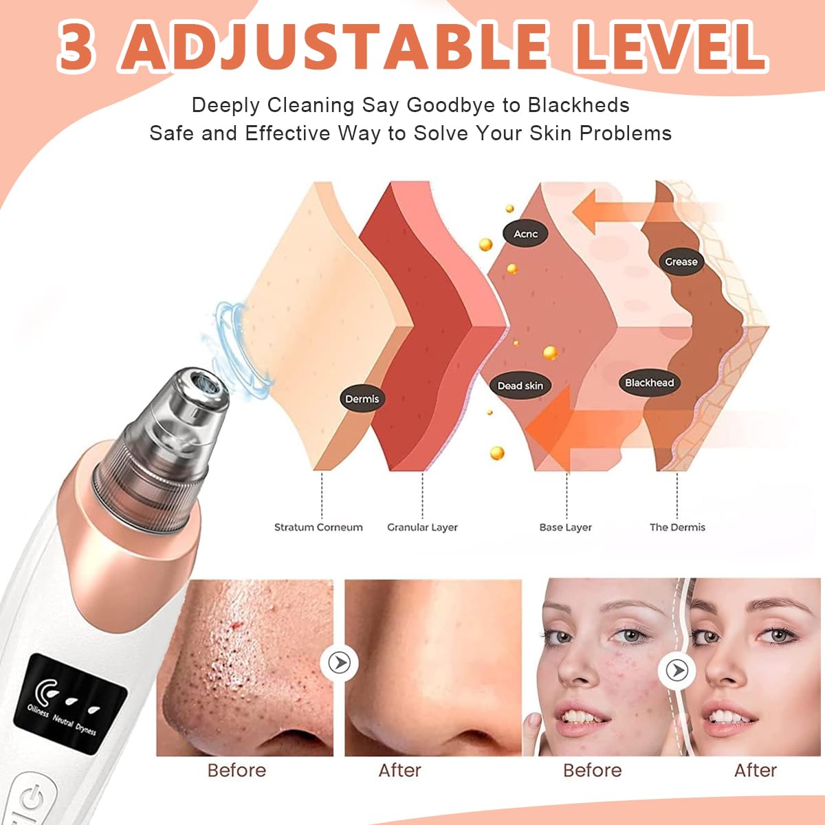 Derma Blackhead Removal